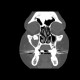 Follicular cyst of the maxillary sinus: CT - Computed tomography